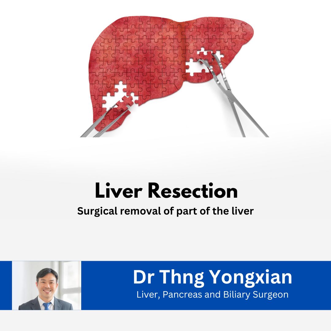 Nexus Surgical (SG) Liver Resection